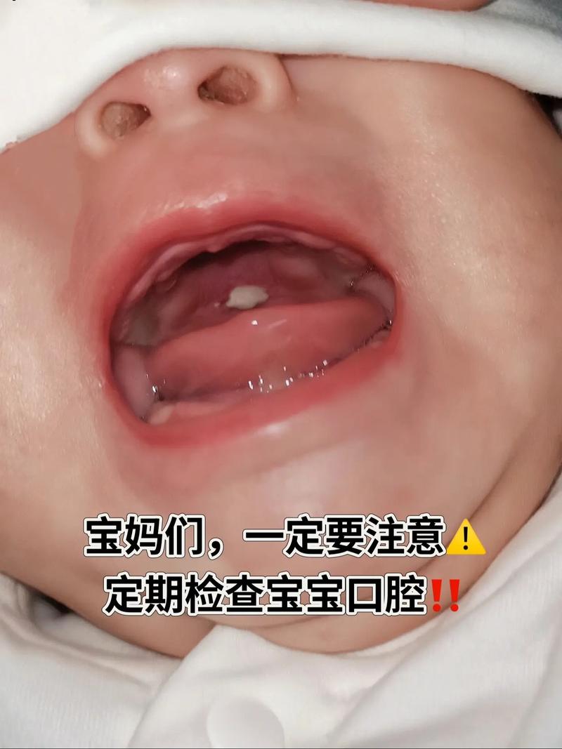 新生儿口腔上颚口疮图怎么看?是鹅口疮吗?