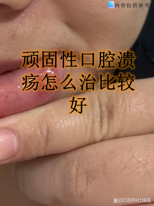口腔溃疡反复怎么办?健康之路视频有妙招?