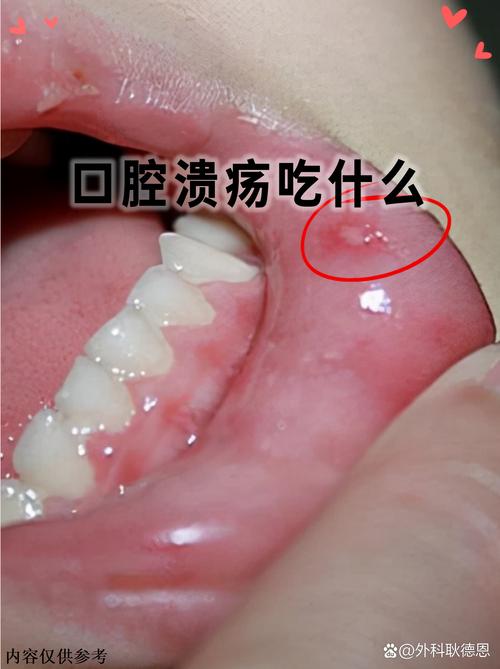 口腔溃疡反复怎么办?健康之路视频有妙招?