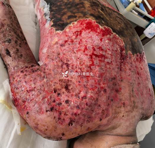 金色葡萄球菌感染皮肤,如何有效应对?