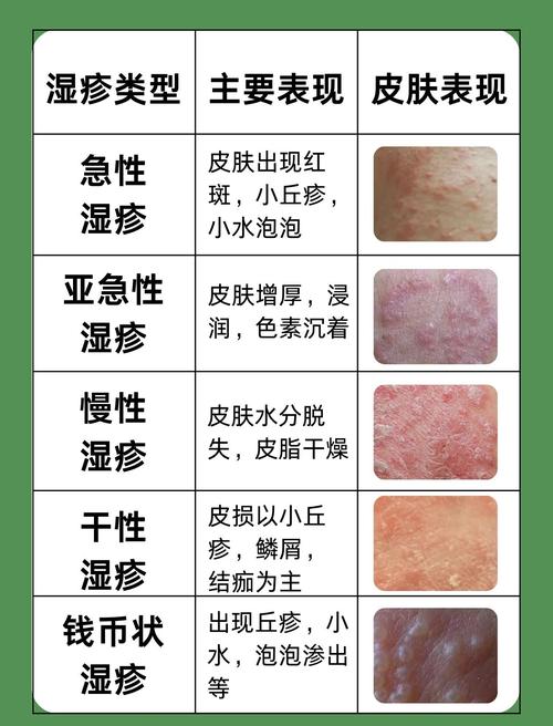 湿疹反复发作,根源到底在哪?