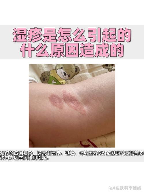 湿疹反复发作,根源到底在哪?