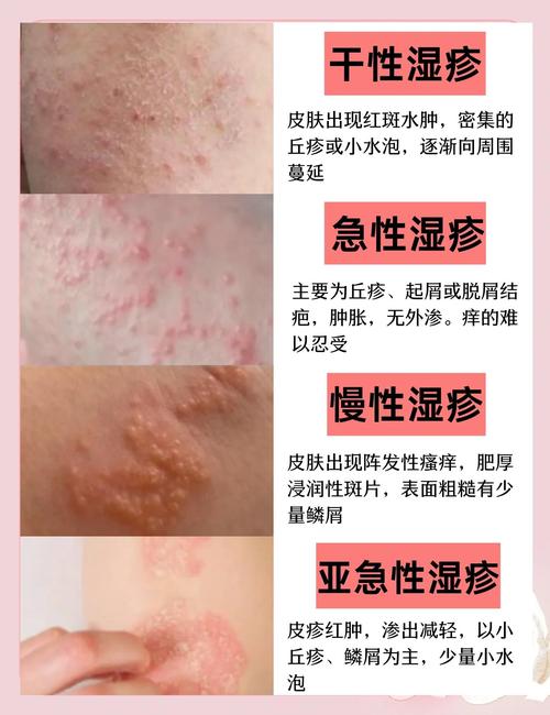 湿疹反复发作,根源到底在哪?