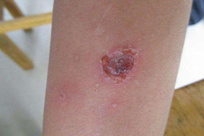 皮肤结痂是何原因?该如何处理?