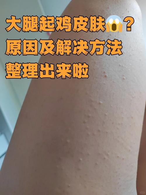 鸡皮肤可以激光脱毛吗