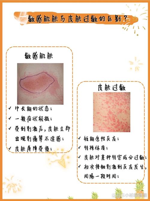 皮肤敏感和过敏到底有何不同?