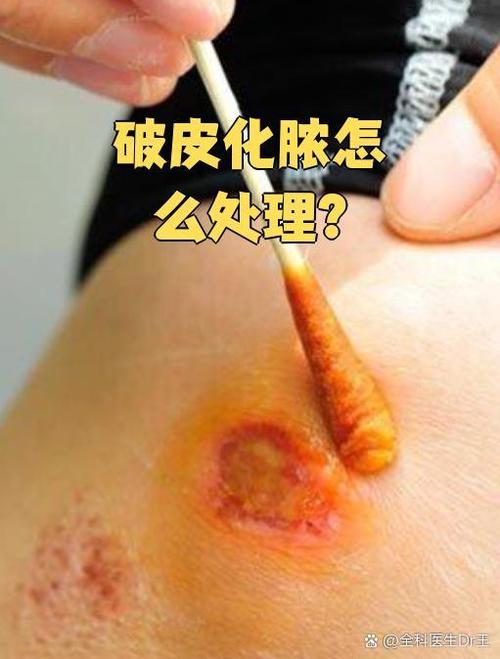 皮肤伤口化脓怎么处理