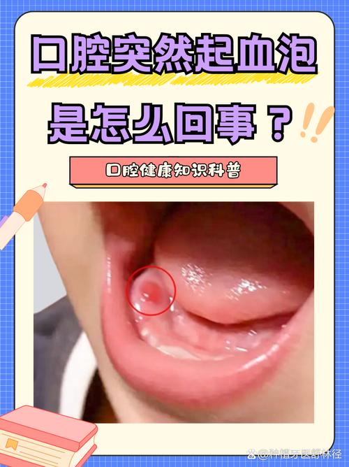 口腔黏膜渗出液怎么取才准确?