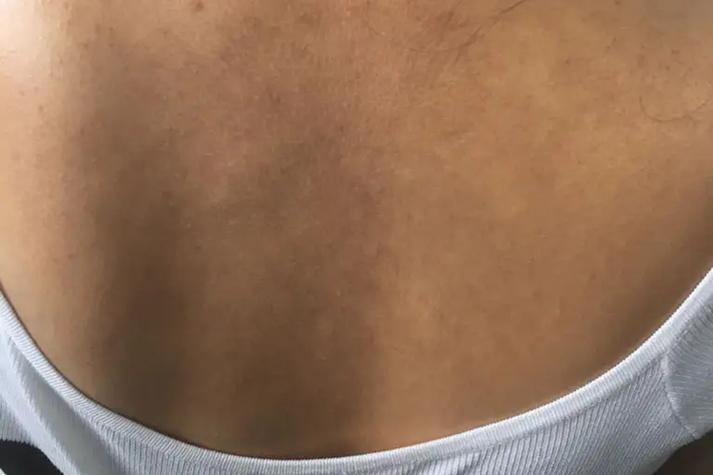 后背皮肤发黑粗糙是何原因?