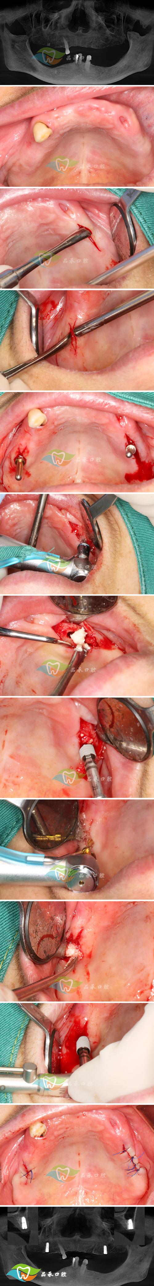 口腔白斑切除手术具体过程是怎样的?