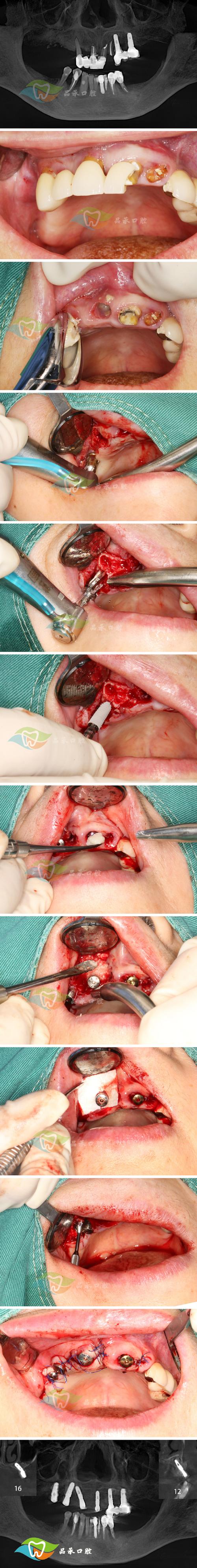 口腔白斑切除手术具体过程是怎样的?