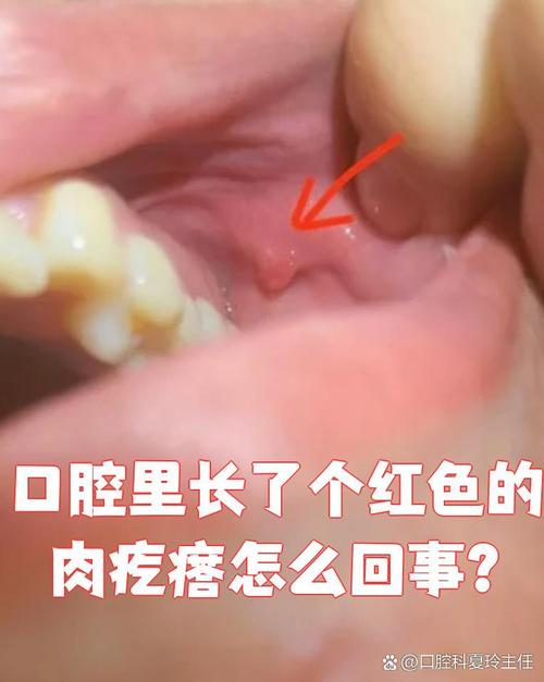 口腔长疙瘩是什么毛病