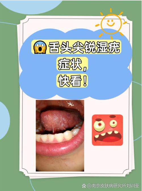 口腔尖锐湿疹会自行消退吗?