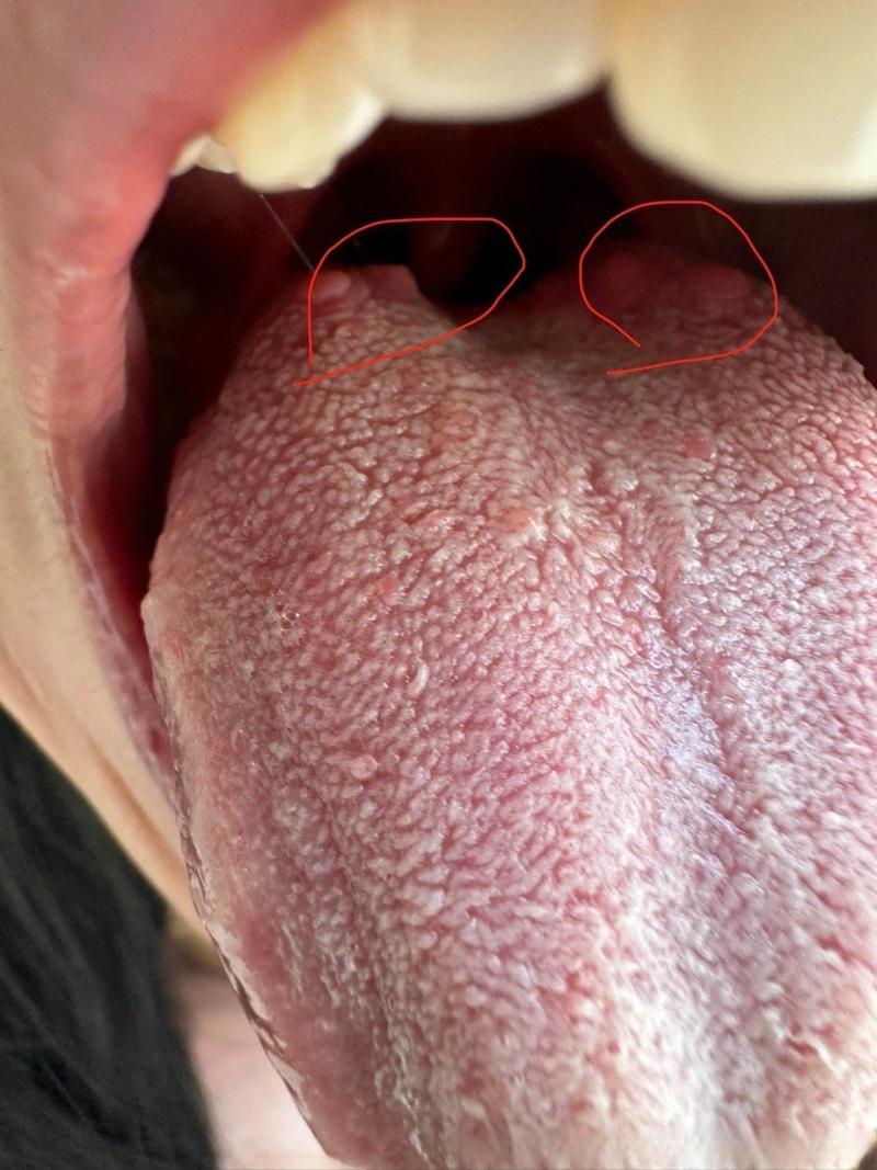 口腔尖锐湿疹会自行消退吗?