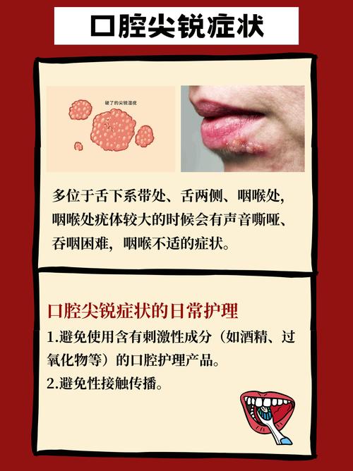 口腔尖锐湿疹会自行消退吗?