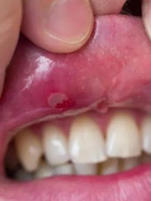 口腔内壁肉瘤是何原因?需警惕吗?