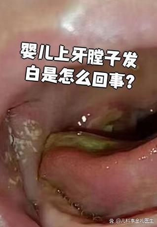宝宝口腔上颚白点是什么?
