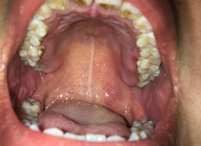 口腔上颚中间白线是啥?正常吗?