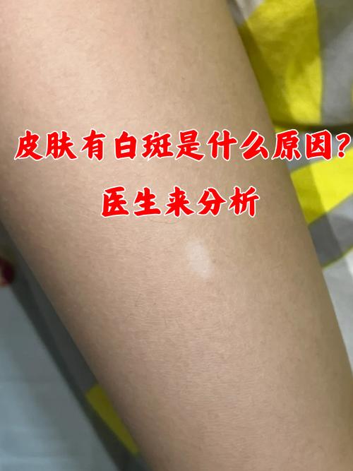 皮肤长白点是啥病?咋治?