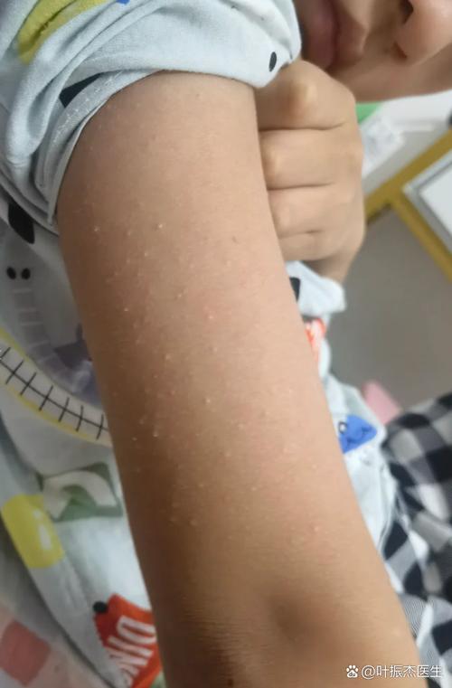 皮肤长白点是啥病?咋治?