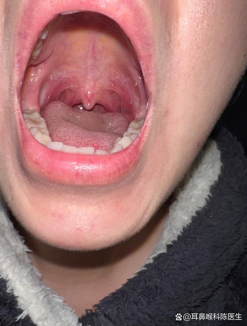 上颚根部吞咽痛,是口腔问题还是其他疾病?