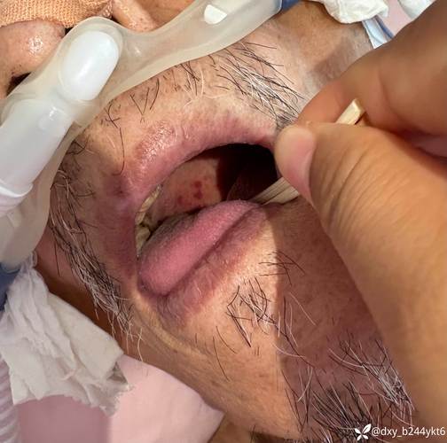 口腔上颚红斑上火照片