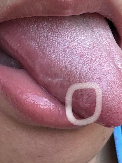 口腔尖锐会有什么症状