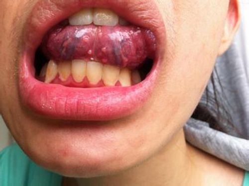 口腔尖锐会有什么症状