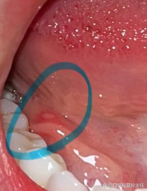 口腔后壁淋巴滤泡增生怎么办?