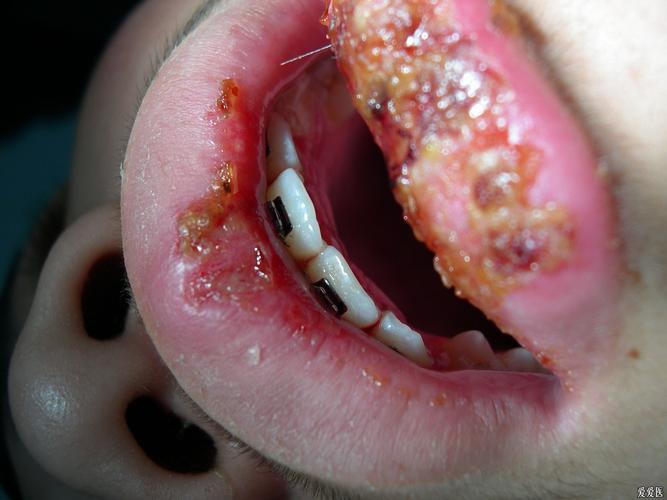 口腔内壁白色黏膜脱落是何原因?