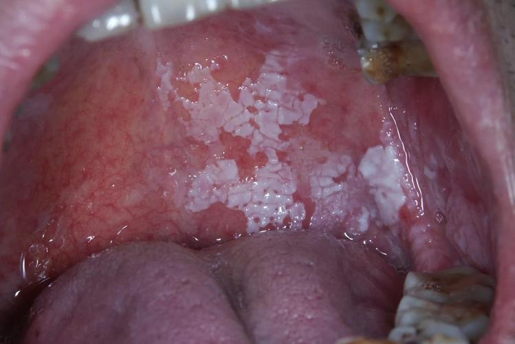 口腔上颚白色颗粒是何原因?