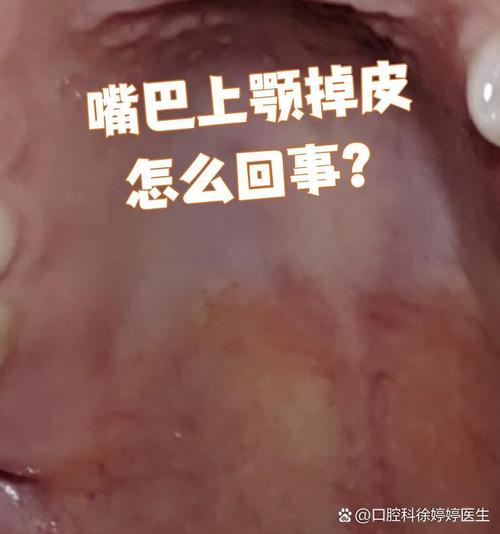 口腔黏膜脱落怎么快速修复?