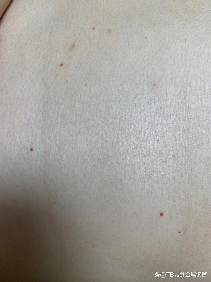 皮肤小红血点痒是过敏还是其他问题？