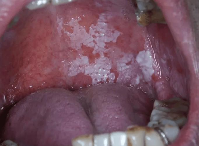 口腔黏膜脱落正常图片有何特征？