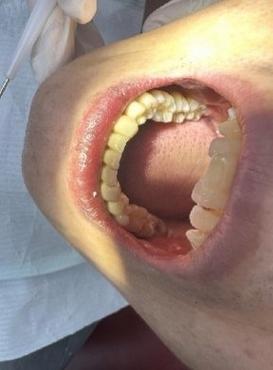 口腔黏膜脱落正常图片有何特征?