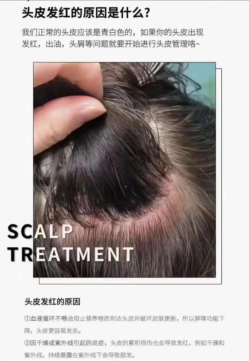 头顶皮肤发红是何原因引起？