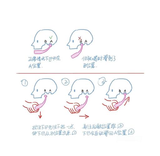 口腔关节错位如何自行复位？