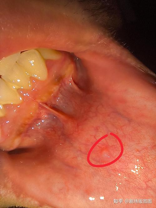 口腔尖锐湿疣有哪些典型症状？