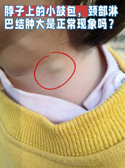 脖子皮肤里的硬疙瘩是啥？要紧吗？