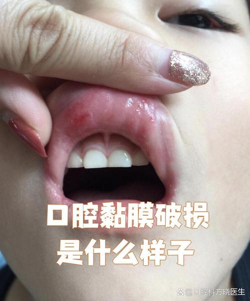 口腔黏膜破损如何快速修复?