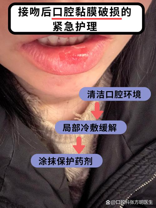 口腔黏膜破损如何快速修复?