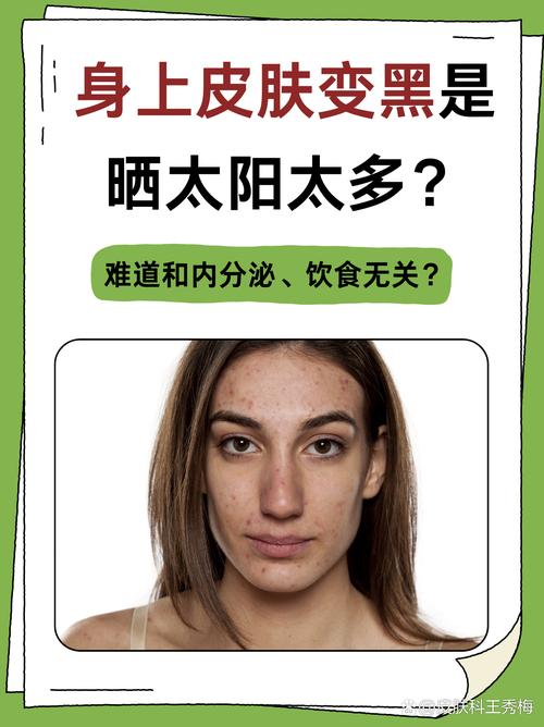 皮肤为何一晒就黑?