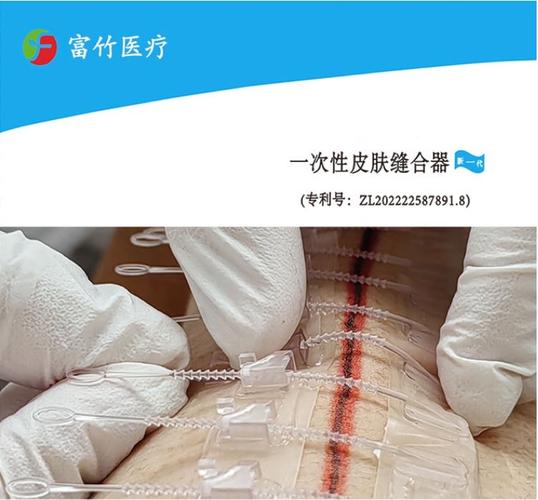 一次性皮肤缝合器真的安全好用吗?