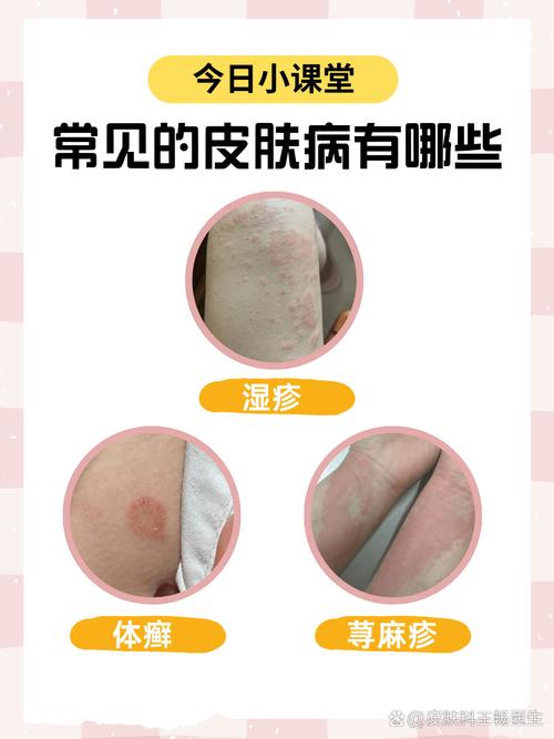 皮肤病种类图片及名称,常见皮肤病有哪些?