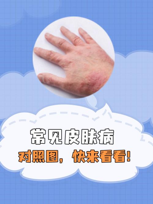 皮肤病种类图片及名称,常见皮肤病有哪些?