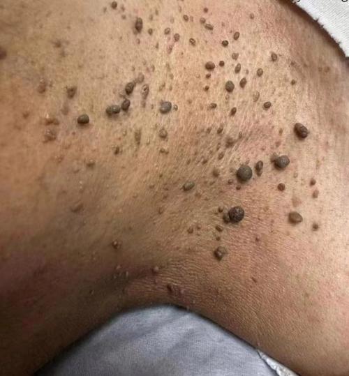 脖子长小肉疙瘩是啥原因?要紧吗?