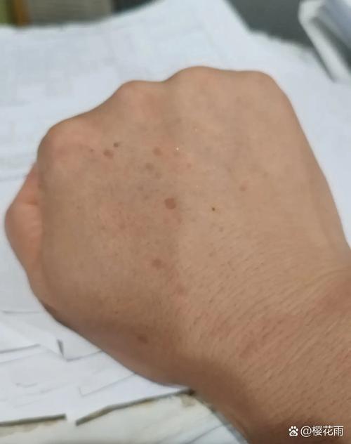 皮肤褐色斑块是何原因?