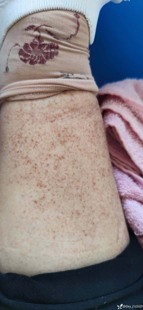 皮肤褐色斑块是何原因?