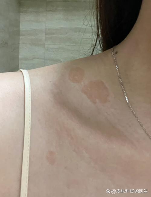 皮肤褐色斑块是何原因?