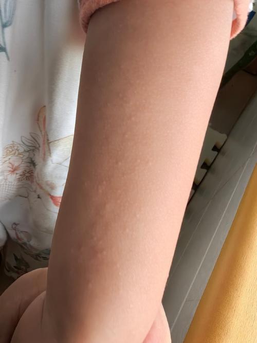 皮肤白色凸起疙瘩是啥病?